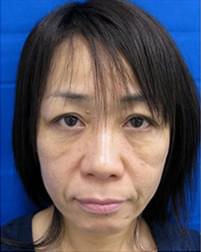 ほうれい線や目の下の凹みラインの正体とは!?